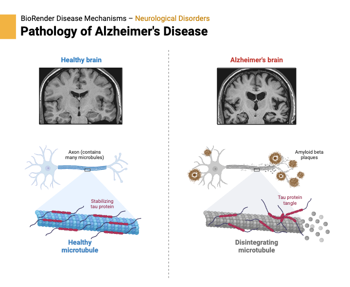 Alzheirmer Hastalığı'nın patolojisinde beta amiloid plakları ve Tau protein birikimleri